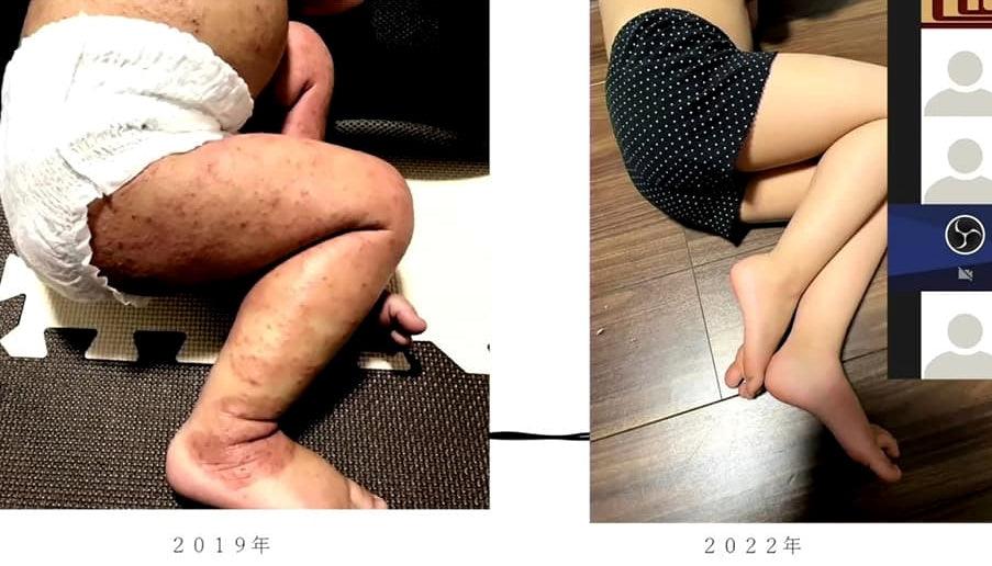 萬醫生濕疹個案分享