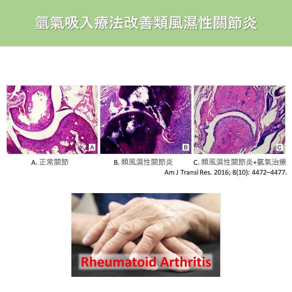 類風濕性關節炎