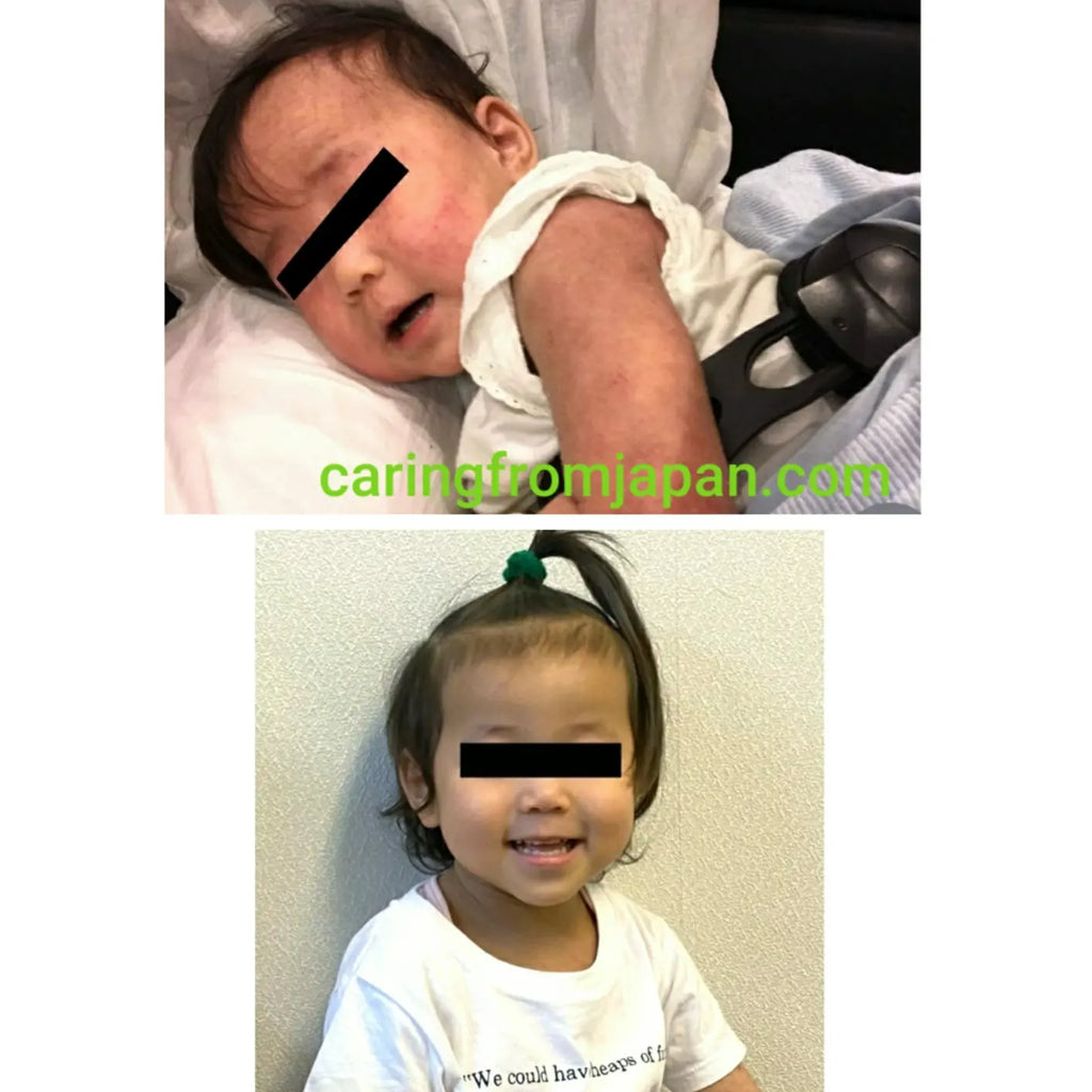 濕疹: 4歲小女孩的故事