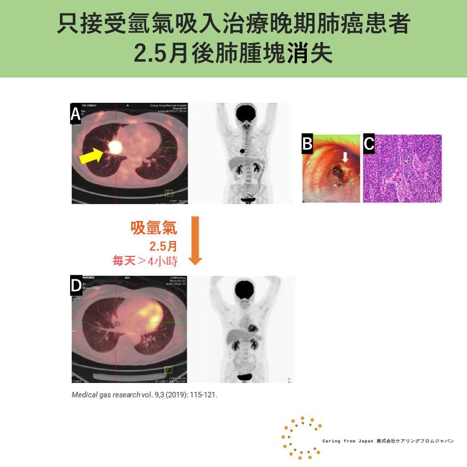 肺癌:沒有常規治療只吸氫氣肺腫塊消失