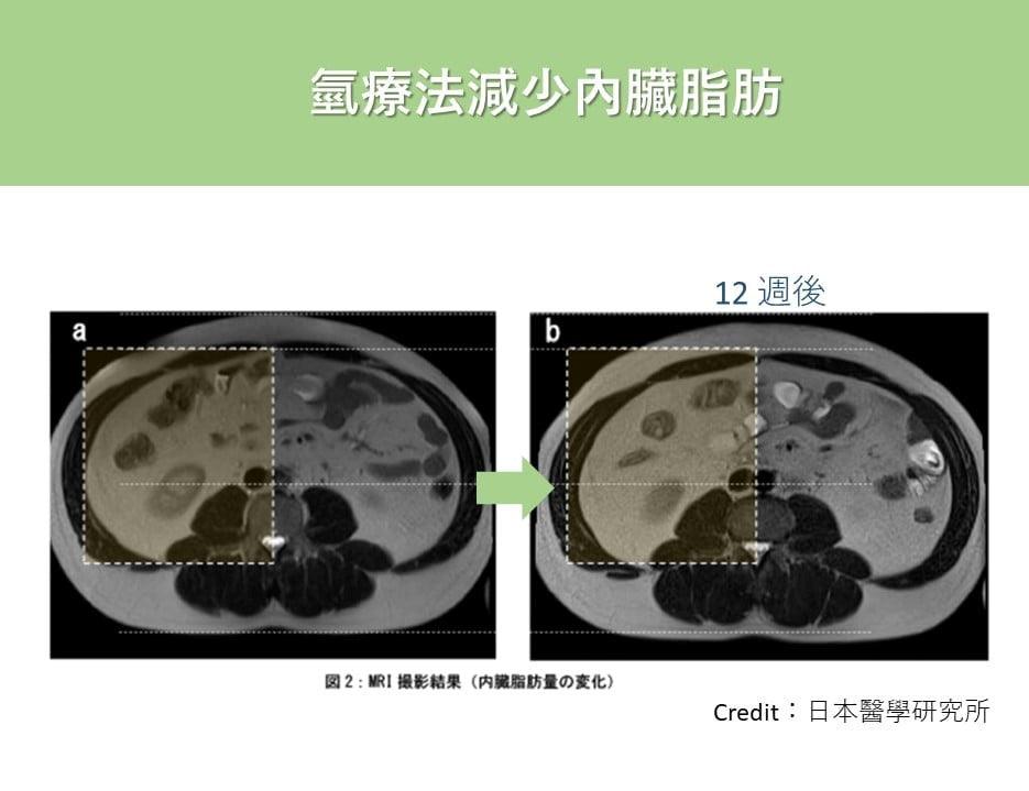 氫療法減少內臟脂肪