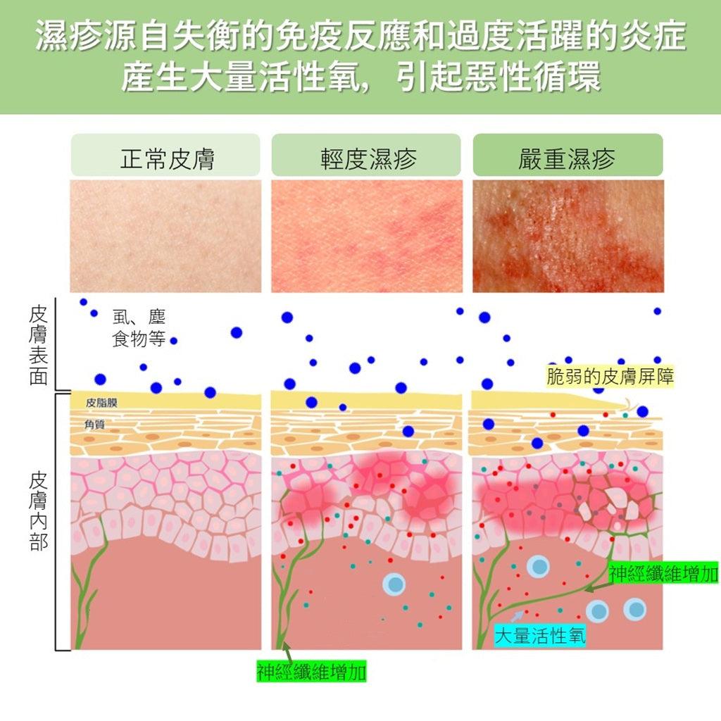 濕疹: 氫療法改善濕疹機理