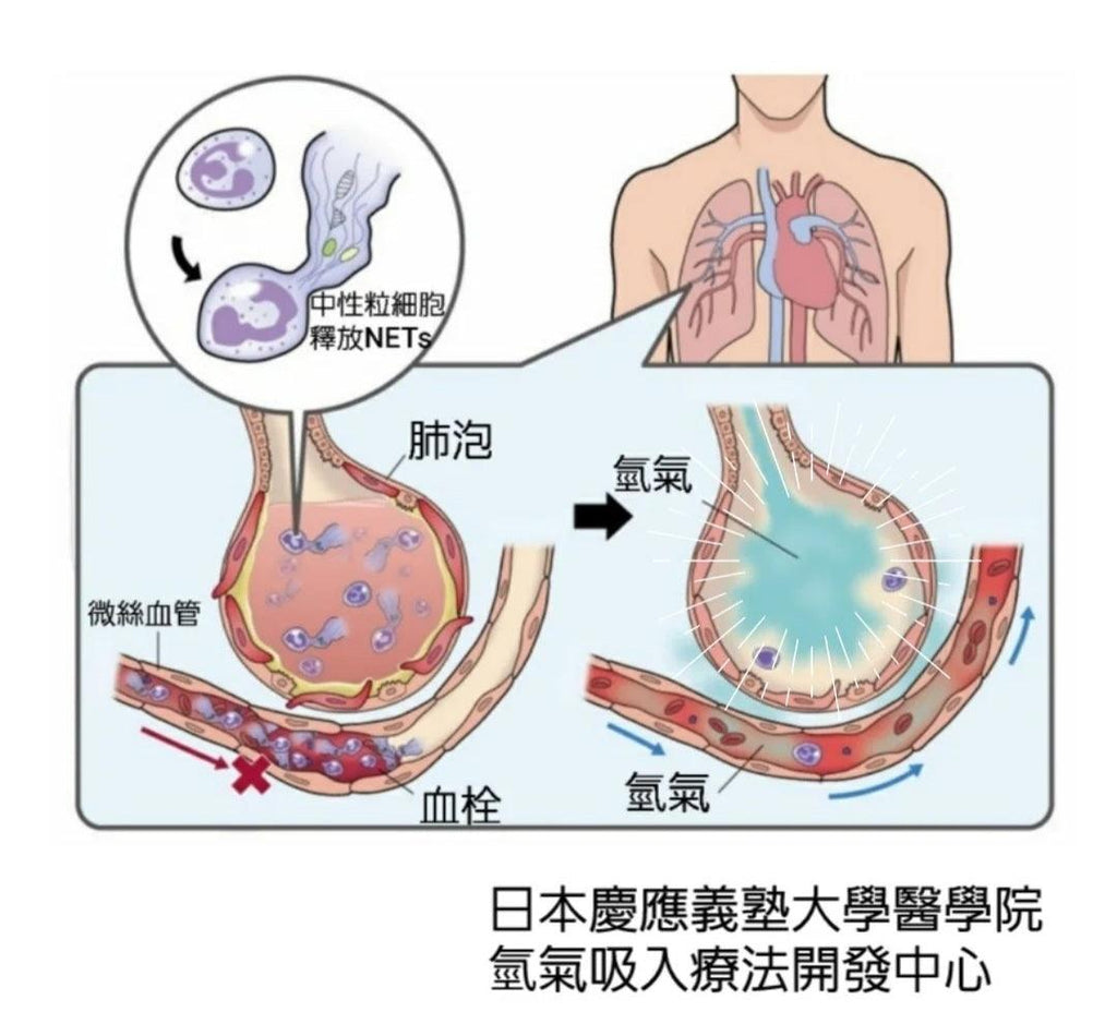 氫氣吸入療法改善/預防新冠病毒感染機理
