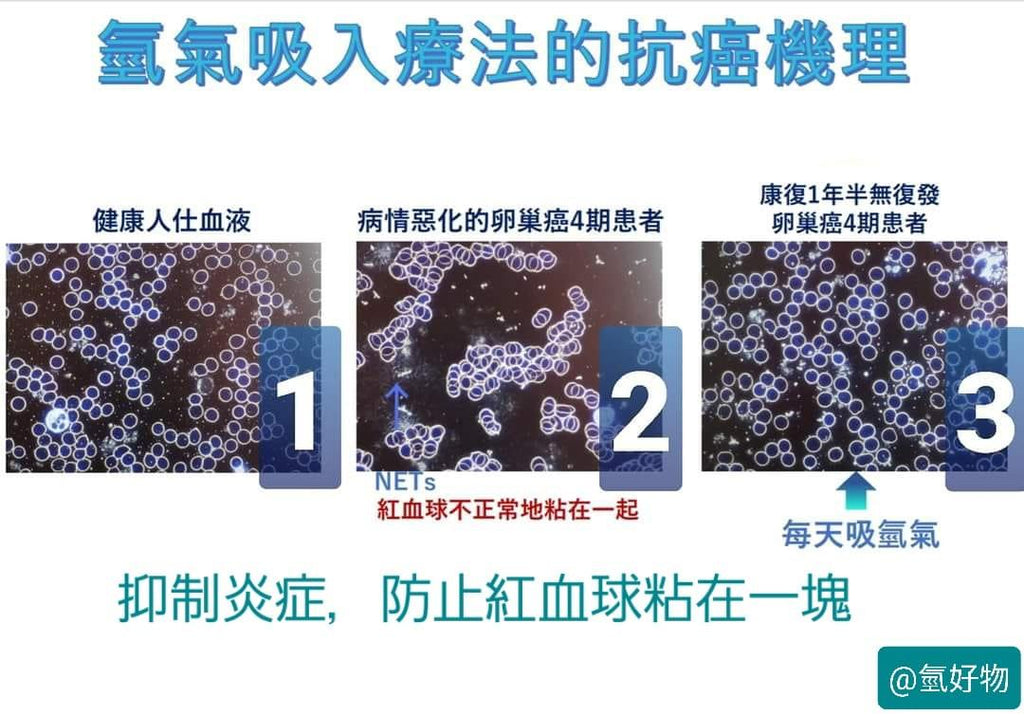 吸氫抑制炎症緩解癌症